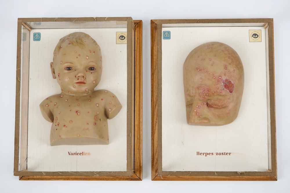Twee wassen doktersmodellen van kinderziektes, Duitsland, midden 20e eeuw