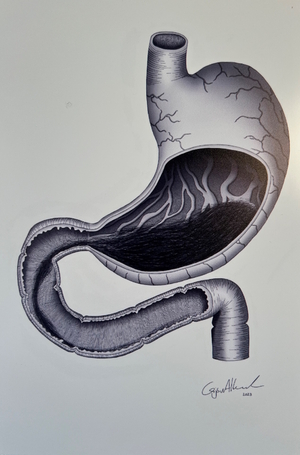 Gijs van Alkemade: 'Trichobezoar with Rapunzel syndrome', digitale pen, in alucobond gemonteerd, 2023