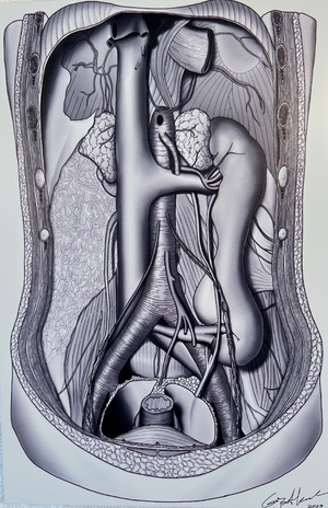 Gijs van Alkemade: 'Crossed Renal Ectopia with Fusion Anomaly', digitale pen, in alucobond gemonteerd, 2023